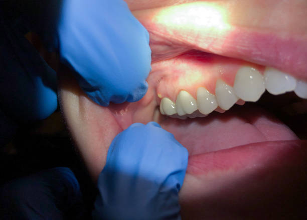Best Emergency Dentist for Lost Fillings or Crowns in Pce, LA